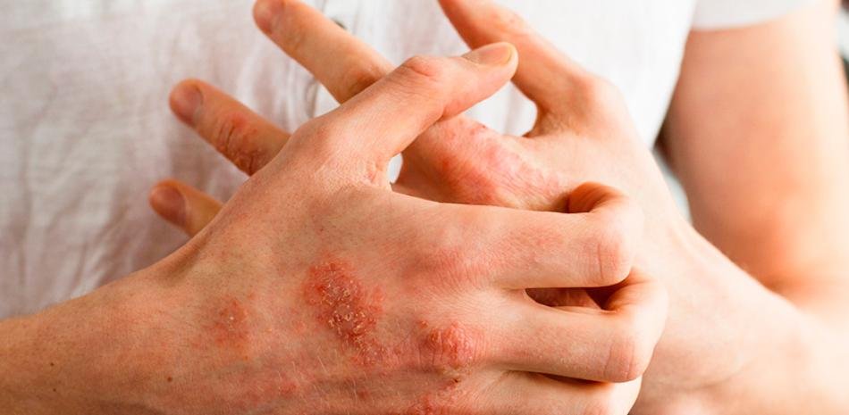 Dermatitis atópica expone una carga silenciosa con impacto en sueño, salud mental y rendimiento